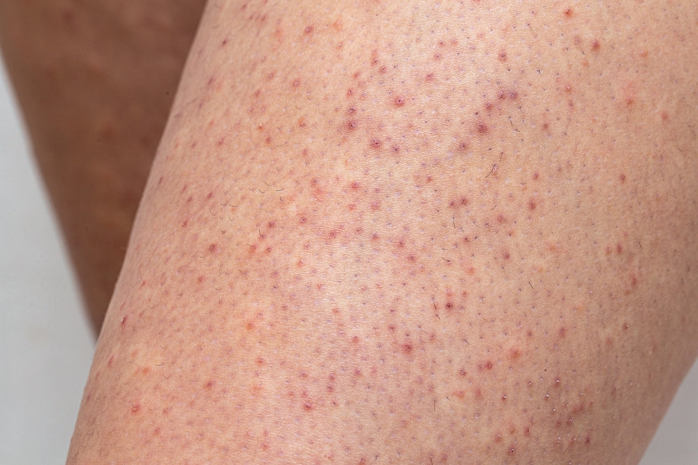 Peau granuleuse sur les bras et les cuisses : causes et solutions